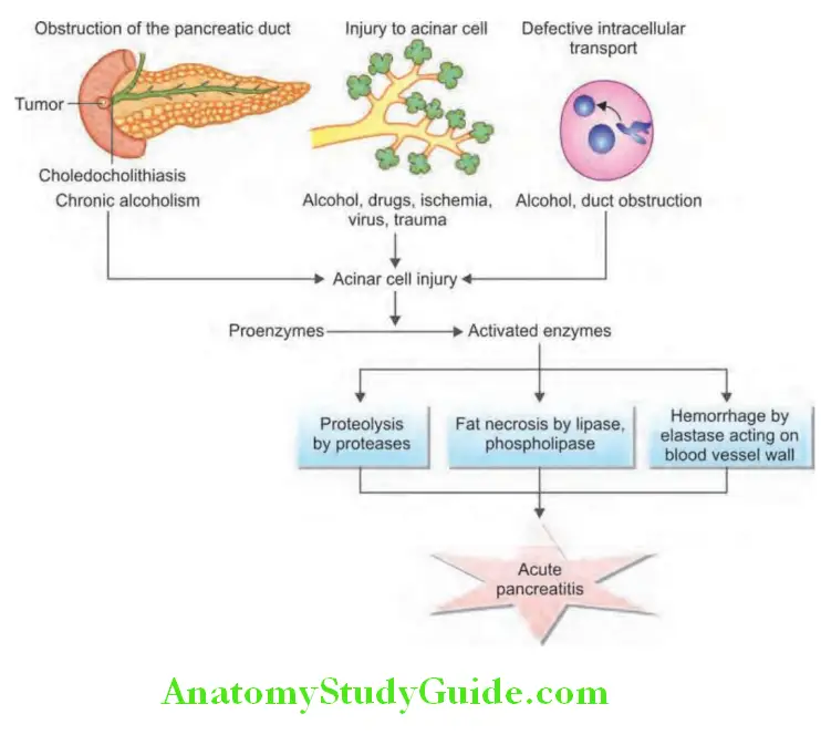 Pancreas Pathogenesis of acute pancreatitis