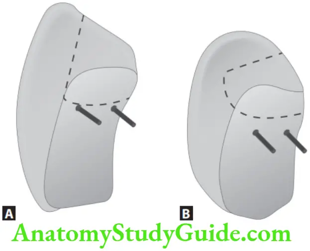 Partial Denture Harmony Facing