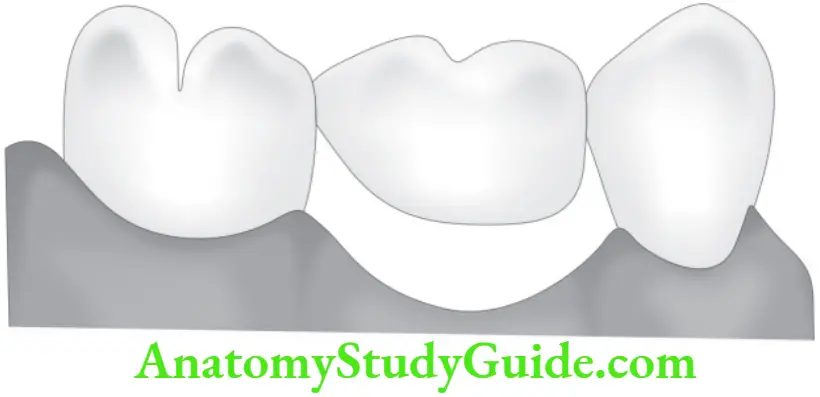 Partial Denture Hygenic pontic