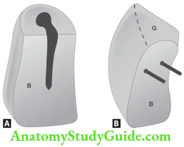 Partial Denture Interchangeable facing