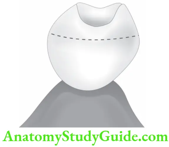 Partial Denture Ovate pontic