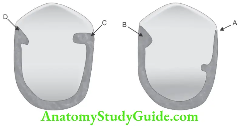Partial Denture Partial Coverage Restorations Groove Preparation