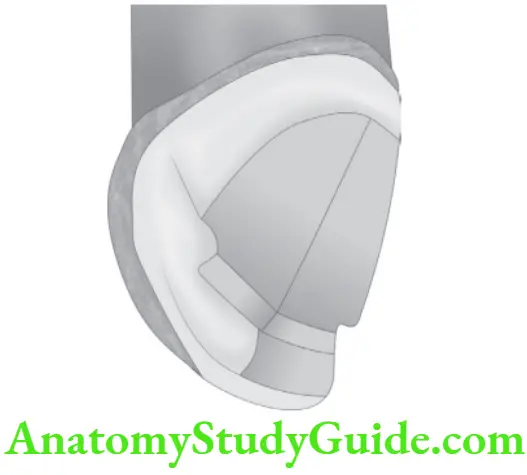 Partial Denture Partial Coverage Restorations Upper canine