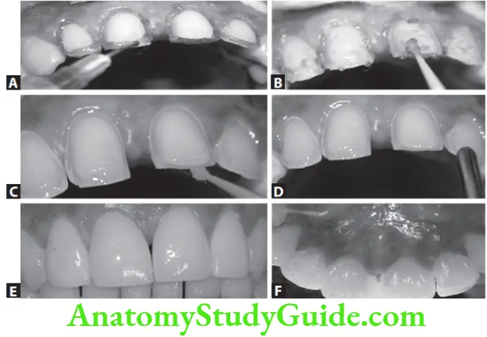 Partial Denture Porcelain Laminate Veneers A Completed case of porcelain veneer