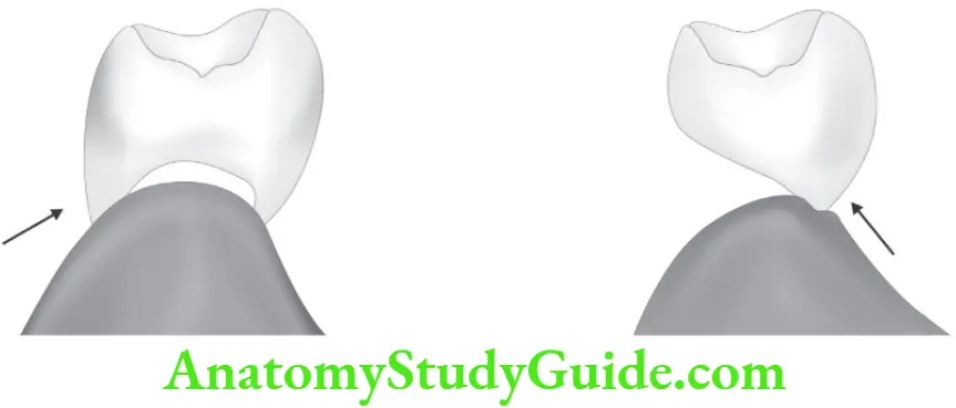 Partial Denture Saddle Ridge lap design and Modified ridge lap