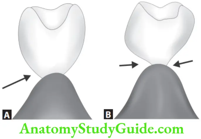 Partial Denture Spheroidal pontic and Modified spheroidal pontic