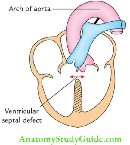 Pericardium And Heart Ventricular Septal Defect