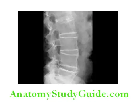 Rheumatology and Connective Tissue Disorders Bamboo spine in ankylosing spondylitis