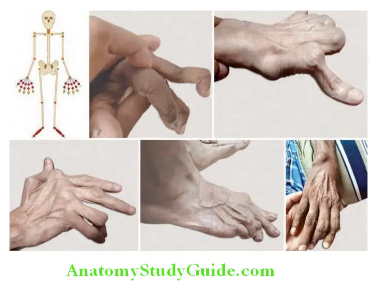 Rheumatology and Connective Tissue Disorders Rheumatoid arthritis