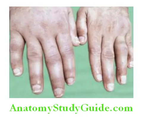 Rheumatology and Connective Tissue Disorders Sausage digits in psoriatic arthritis and psoriatic nails