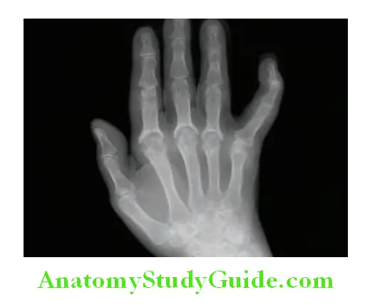 Rheumatology and Connective Tissue Disorders X-ray of hand shows pencil-in-cup appearance in psoriatic arthritis