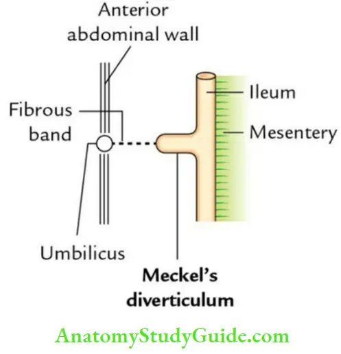 Small And Large Intestines Meckles Diverticulum