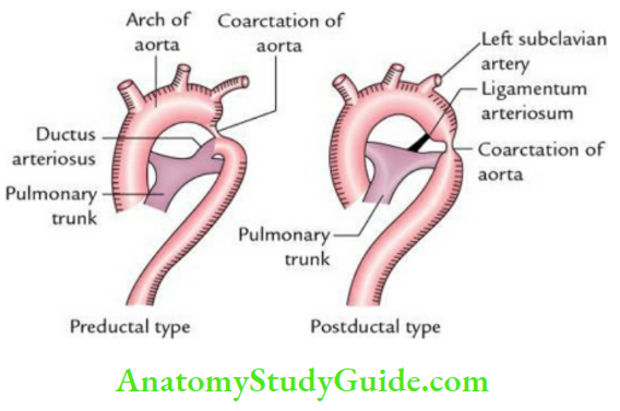 Superior Vena Cava Aorta Pulmonary Trunk And Thymus Coarcation Of Aorta
