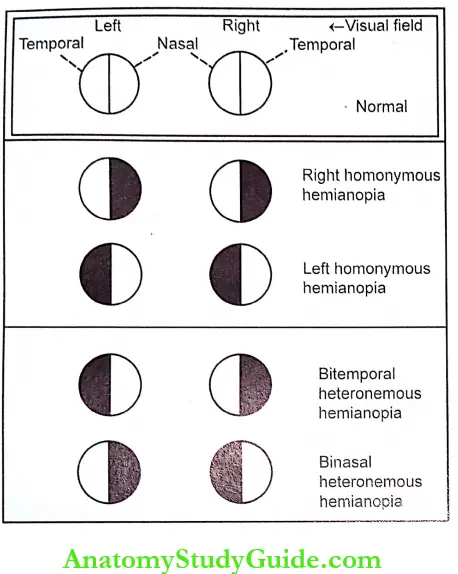 Visual Pathway Types Of Hemianopia