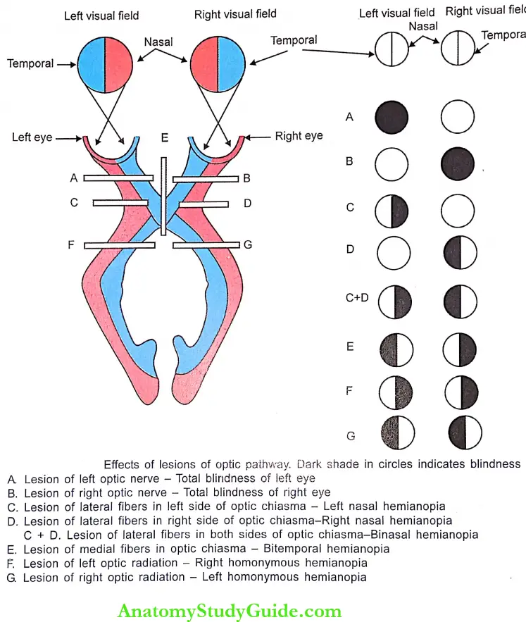 Visual Pathway effects Of Lessions Of Optic Pathway