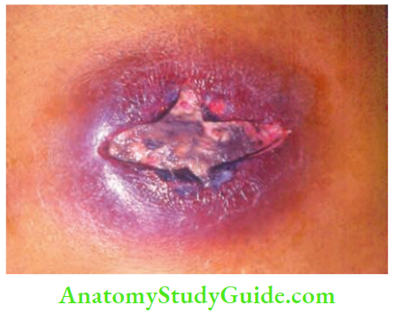 Acute Infections Sinuses Fistula And Surgical Site Infection Carbuncle With Central Slough