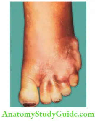 Acute Infections Sinuses Fistula And Surgical Site Infection Cellulitis Of The Foot With Abscess