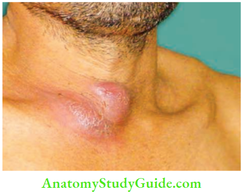 Acute Infections Sinuses Fistula And Surgical Site Infection Cold Abscess Of The Right Sternoclavicular Joint