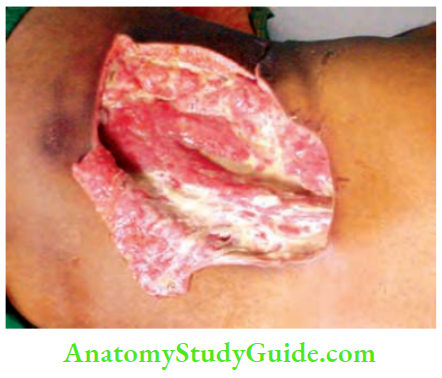 Acute Infections Sinuses Fistula And Surgical Site Infection Extensive Pyomyositis Affecting Muscles Of The Back