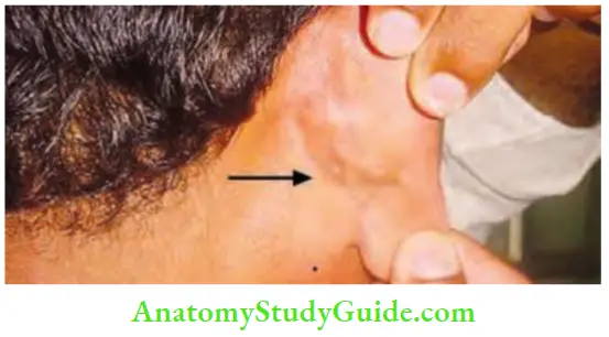 Acute Infections Sinuses Fistula And Surgical Site Infection Postauricular Sinus