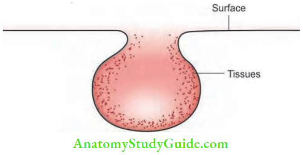 Acute Infections Sinuses Fistula And Surgical Site Infection Sinus (Blind Track)