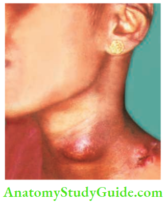 Acute Infections Sinuses Fistula And Surgical Site Infection TB Lymphadenitis Cold Abscess