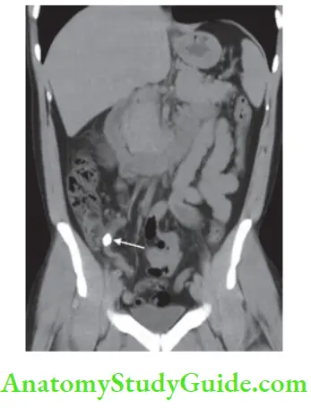 Appendix CT Scan In Acute Appendicitis