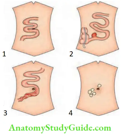 Appendix In Children