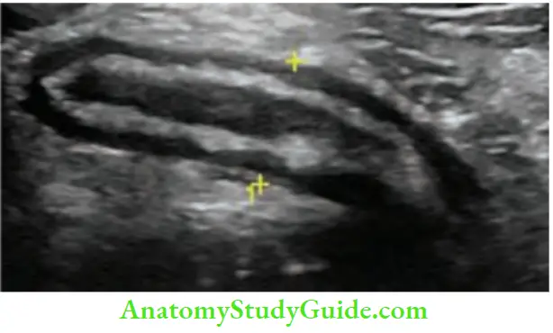 Appendix Ultrasound Of Appendix
