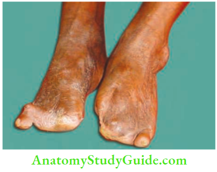 Chronic Infectious Disease Autoamputation Of The Toes In A Case Of Leprosy