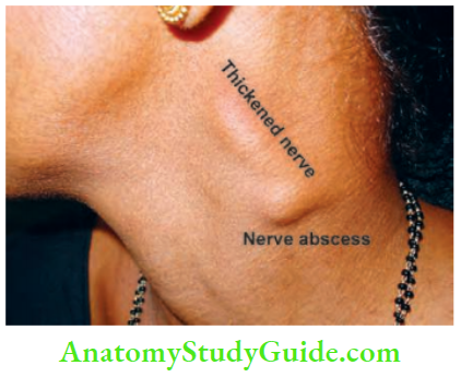 Chronic Infectious Disease Nerve Abscess And Thickened Postauricular Nerve