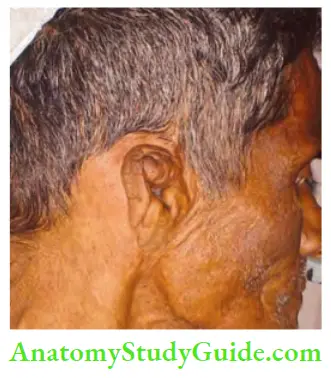 Chronic Infectious Disease Observe Deformed Ear