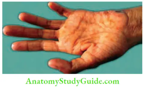 Chronic Infectious Disease Small Muscles Atrophy In The Hand