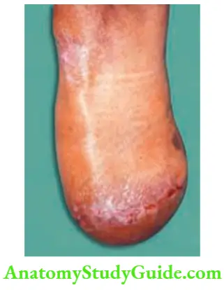 Differential Diagnosis Of Leg Ulcer And Pressure Sore Below Knee Amputation
