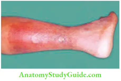 Differential Diagnosis Of Leg Ulcer And Pressure Sore Cellulitis Leg