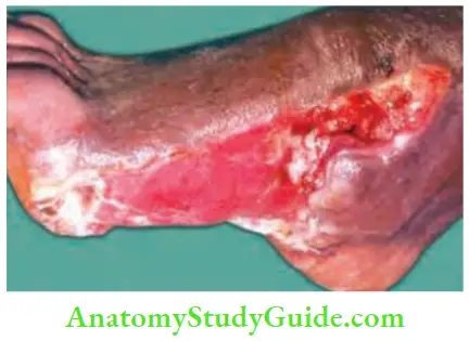 Differential Diagnosis Of Leg Ulcer And Pressure Sore Clawing Of Toes