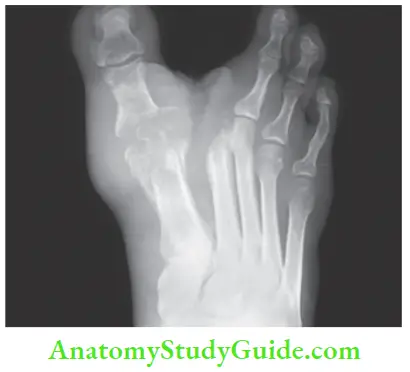 Differential Diagnosis Of Leg Ulcer And Pressure Sore Destruction Of Metatarsal Bone And Dislocation Of Metatarsal Joint