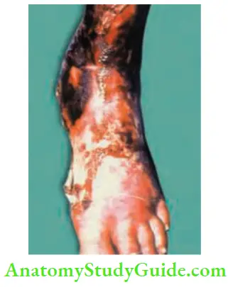 Differential Diagnosis Of Leg Ulcer And Pressure Sore Diabetic Ulcer With Most Gangrene