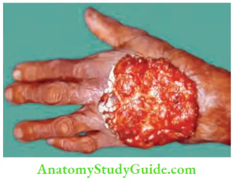 Differential Diagnosis Of Leg Ulcer And Pressure Sore Everted Edge Squamous Cell Carcinoma