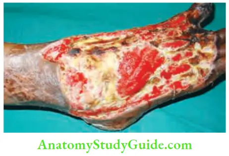 Differential Diagnosis Of Leg Ulcer And Pressure Sore Five Days Of Usage Of Epidermal Growth Factor Granulation Tissue Started Growing