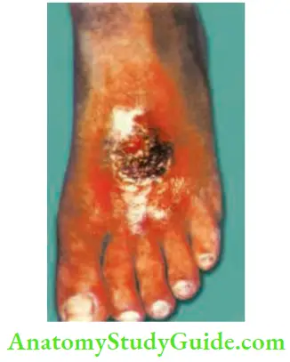 Differential Diagnosis Of Leg Ulcer And Pressure Sore Ischaemic Ulcer On The Dorsum Of The Foot Typical Site