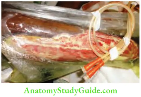 Differential Diagnosis Of Leg Ulcer And Pressure Sore Limited Access Dressing