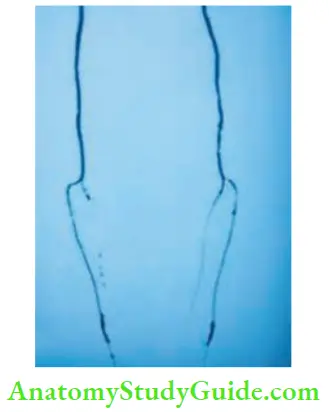 Differential Diagnosis Of Leg Ulcer And Pressure Sore Lower Limb Angiogram Note The Bilateral Infrapopliteal Arterial Disease