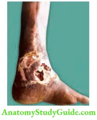 Differential Diagnosis Of Leg Ulcer And Pressure Sore Maggots In Diabetic Patient Who Had Venous Ulcer