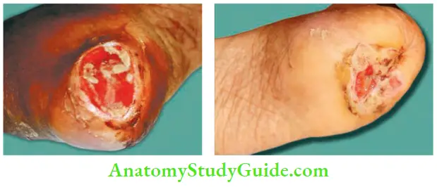 Differential Diagnosis Of Leg Ulcer And Pressure Sore Neuropathic Ulcer Classical Site Over Heel