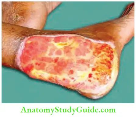Differential Diagnosis Of Leg Ulcer And Pressure Sore Pale Granulation Tissue And Purulent Discharge