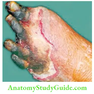Differential Diagnosis Of Leg Ulcer And Pressure Sore Polycythaemia Causing Gangrene Of Toes