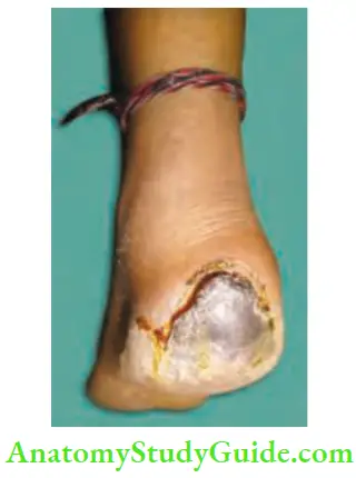 Differential Diagnosis Of Leg Ulcer And Pressure Sore Pressure Gangrene Sore Over Heel