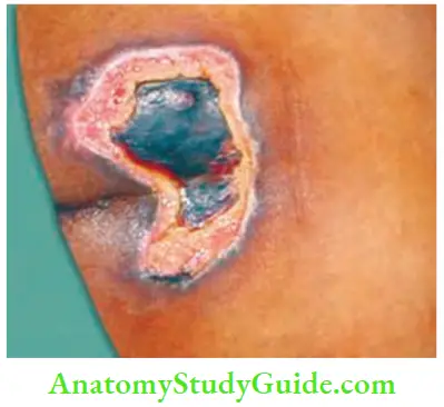Differential Diagnosis Of Leg Ulcer And Pressure Sore Pressure Sore