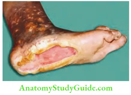 Differential Diagnosis Of Leg Ulcer And Pressure Sore Punched Out Edge Neuropathic Ulcer